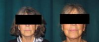 Patient treated with Full Facelift & Neck Lift
