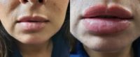Patient treated with Lip Augmentation