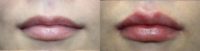 Young female looking for lip enhancement